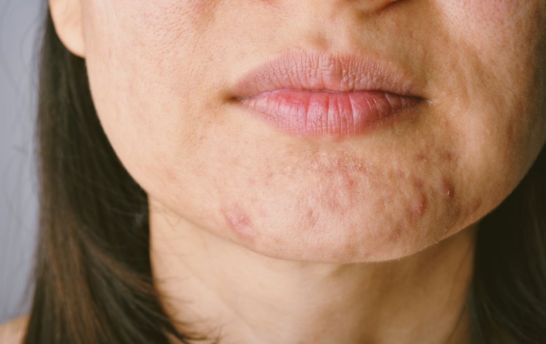 Why am I getting Acne at 40? And more Skin Changes affected by Perimenopause